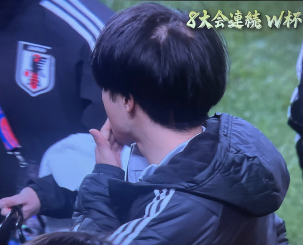 2024年〜2026年現在の頭頂部の変化